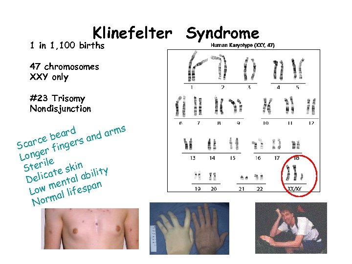 Klinefelter Syndrome 1 in 1, 100 births 47 chromosomes XXY only #23 Trisomy Nondisjunction