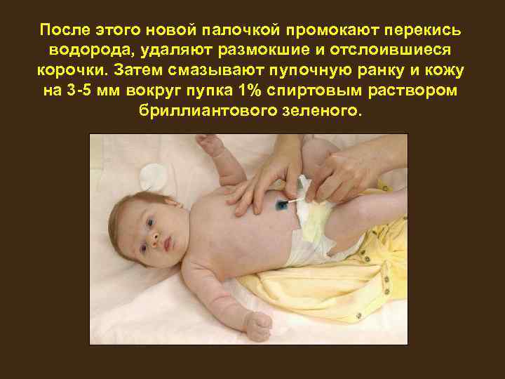 После этого новой палочкой промокают перекись водорода, удаляют размокшие и отслоившиеся корочки. Затем смазывают