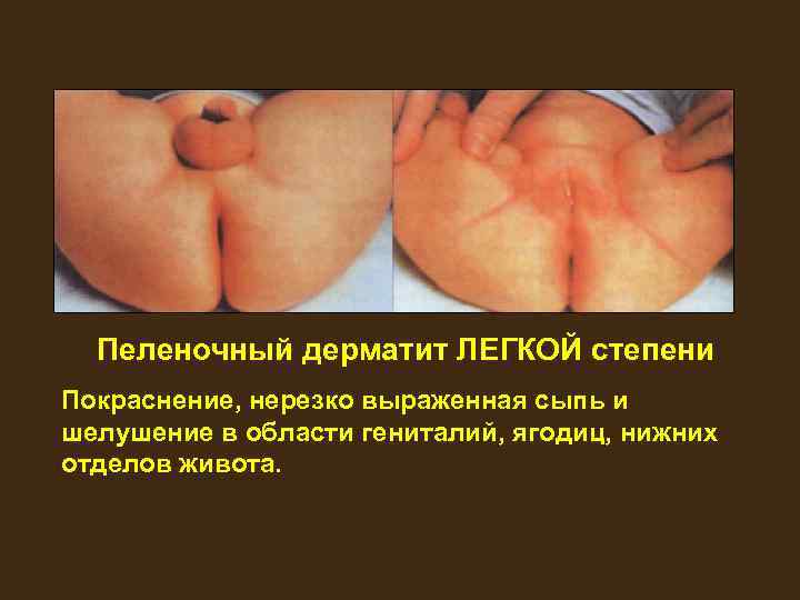 Пеленочный дерматит ЛЕГКОЙ степени Покраснение, нерезко выраженная сыпь и шелушение в области гениталий, ягодиц,