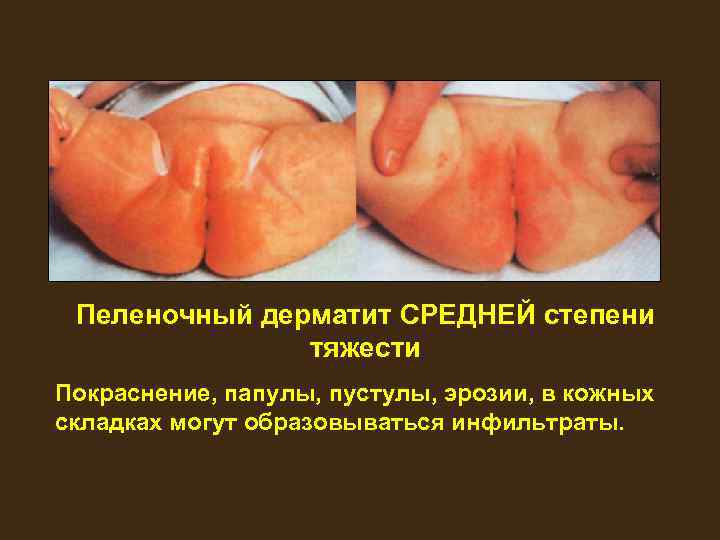 Пеленочный дерматит СРЕДНЕЙ степени тяжести Покраснение, папулы, пустулы, эрозии, в кожных складках могут образовываться