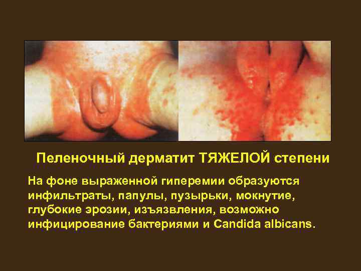 Пеленочный дерматит ТЯЖЕЛОЙ степени На фоне выраженной гиперемии образуются инфильтраты, папулы, пузырьки, мокнутие, глубокие