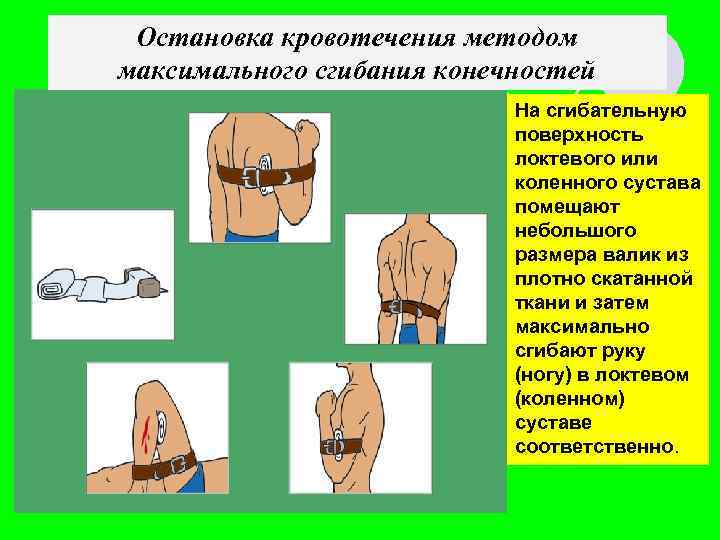Остановка кровотечения методом максимального сгибания конечностей На сгибательную поверхность локтевого или коленного сустава помещают
