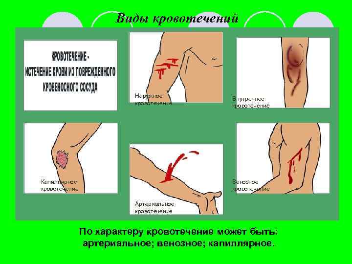 Виды кровотечений Наружное кровотечение Капиллярное кровотечение Внутреннее кровотечение Венозное кровотечение Артериальное кровотечение По характеру