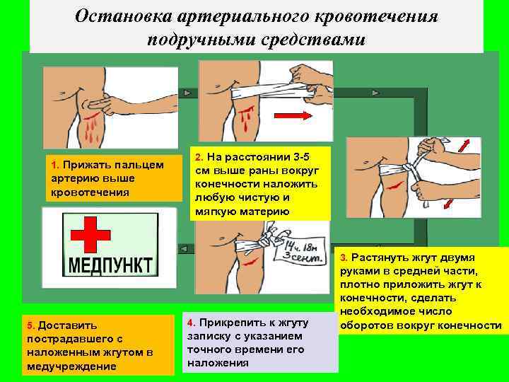 Остановка артериального кровотечения подручными средствами 1. Прижать пальцем артерию выше кровотечения 2. На расстоянии