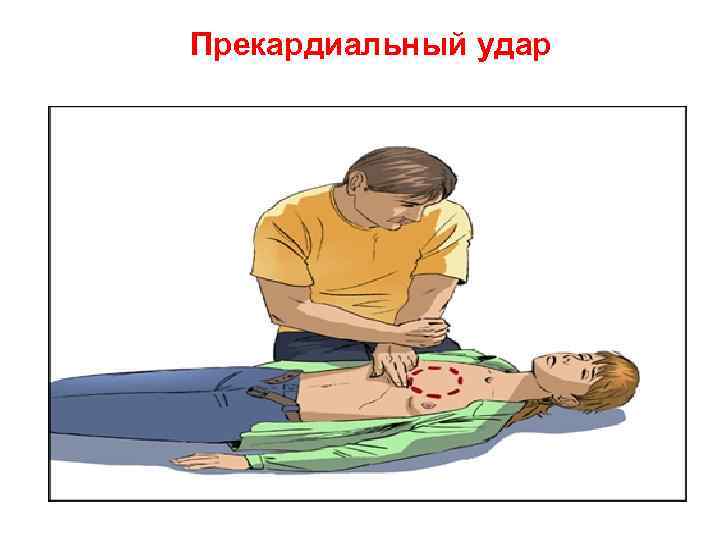 Прекардиальный удар 