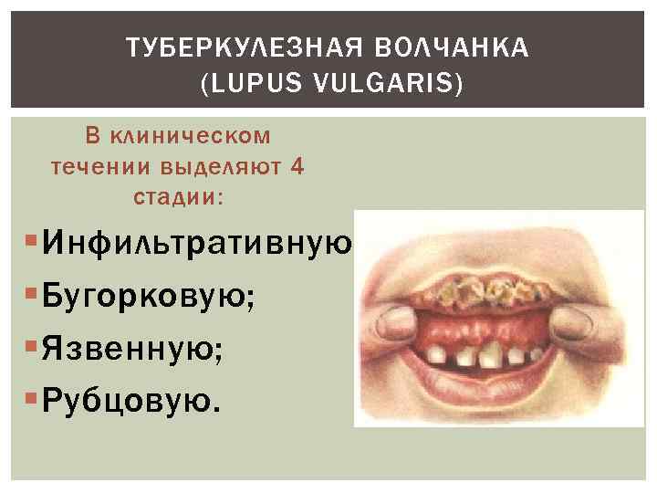 ТУБЕРКУЛЕЗНАЯ ВОЛЧАНКА (LUPUS VULGARIS) В клиническом течении выделяют 4 стадии: § Инфильтративную; § Бугорковую;