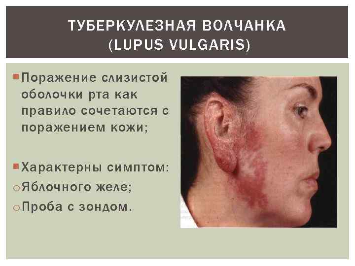 ТУБЕРКУЛЕЗНАЯ ВОЛЧАНКА (LUPUS VULGARIS) Поражение слизистой оболочки рта как правило сочетаются с поражением кожи;