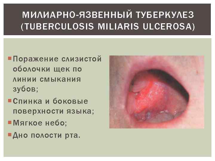 МИЛИАРНО-ЯЗВЕННЫЙ ТУБЕРКУЛЕЗ (TUBERCULOSIS MILIARIS ULCEROSA) Поражение слизистой оболочки щек по линии смыкания зубов; Спинка