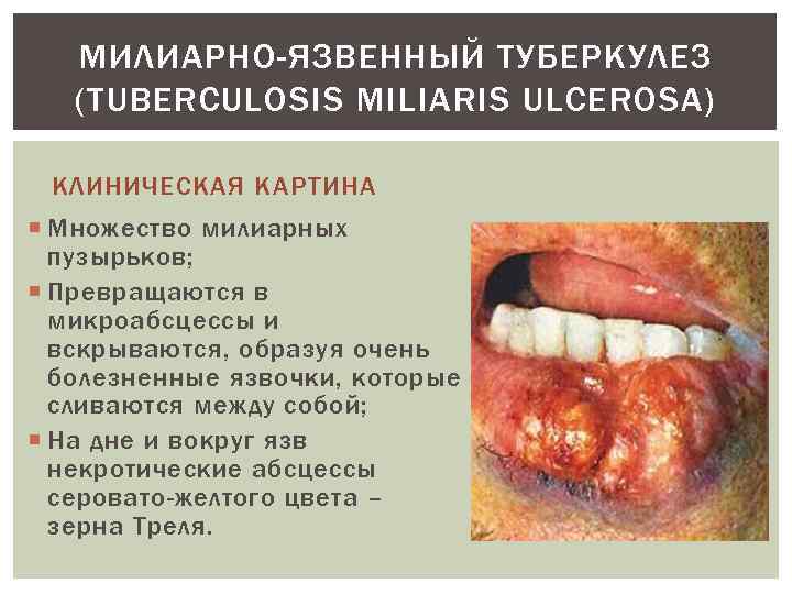 МИЛИАРНО-ЯЗВЕННЫЙ ТУБЕРКУЛЕЗ (TUBERCULOSIS MILIARIS ULCEROSA) КЛИНИЧЕСКАЯ КАРТИНА Множество милиарных пузырьков; Превращаются в микроабсцессы и