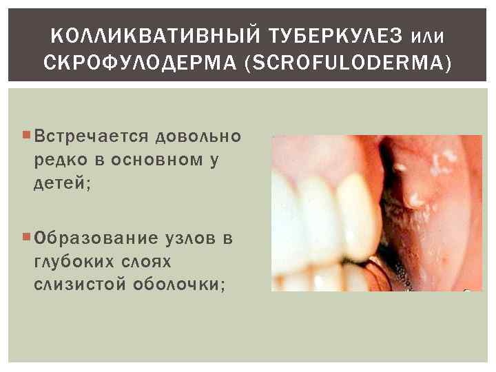 КОЛЛИКВАТИВНЫЙ ТУБЕРКУЛЕЗ ИЛИ СКРОФУЛОДЕРМА (SCROFULODERMA) Встречается довольно редко в основном у детей; Образование узлов