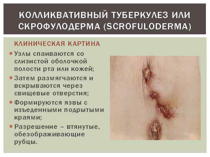 КОЛЛИКВАТИВНЫЙ ТУБЕРКУЛЕЗ ИЛИ СКРОФУЛОДЕРМА (SCROFULODERMA) КЛИНИЧЕСКАЯ КАРТИНА Узлы спаиваются со слизистой оболочкой полости рта