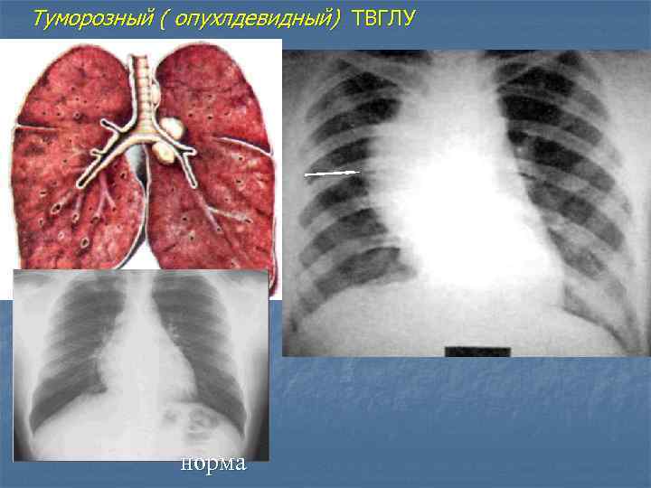 Туморозный ( опухлдевидный) ТВГЛУ норма 