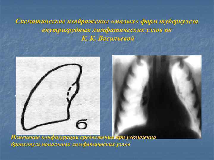 Схематическое изображение «малых» форм туберкулеза внутригрудных лимфатических узлов по К. К. Васильевой • Изменение