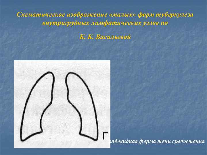 Схематическое изображение «малых» форм туберкулеза внутригрудных лимфатических узлов по К. К. Васильевой колбовидная форма
