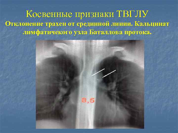 Косвенные признаки ТВГЛУ Отклонение трахеи от срединной линии. Кальцинат лимфатичекого узла Баталлова протока. 