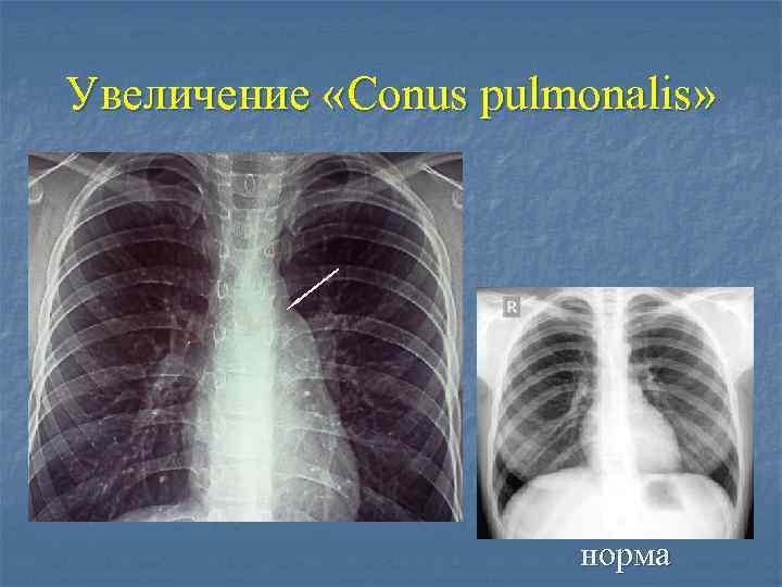 Увеличение «Conus pulmonalis» норма 