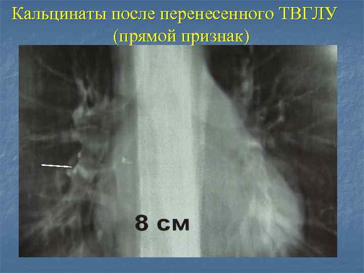 Кальцинаты после перенесенного ТВГЛУ (прямой признак) 