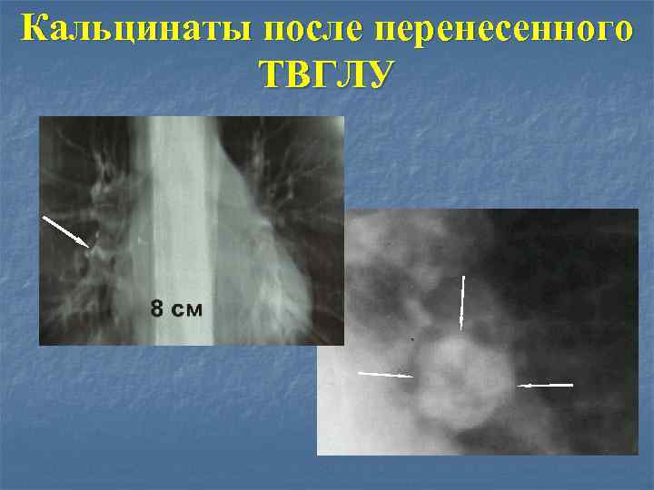 Кальцинаты после перенесенного ТВГЛУ 