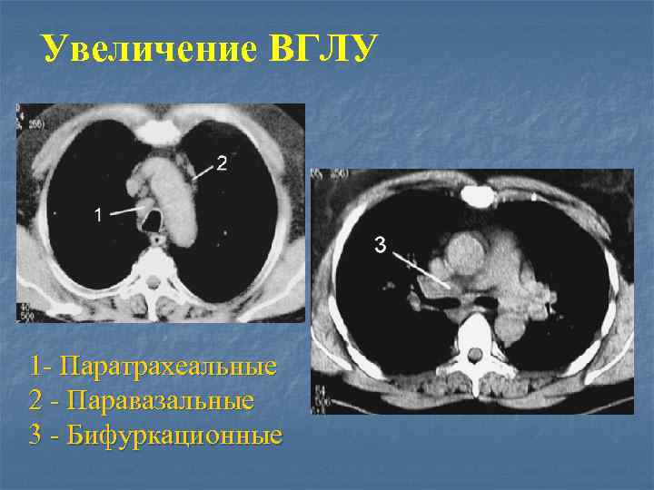 Увеличение ВГЛУ 1 - Паратрахеальные 2 - Паравазальные 3 - Бифуркационные 