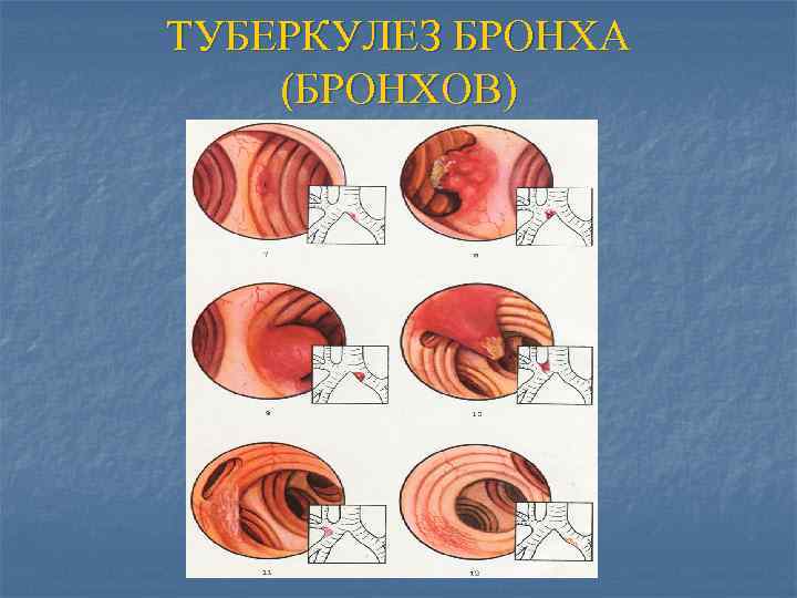 ТУБЕРКУЛЕЗ БРОНХА (БРОНХОВ) 