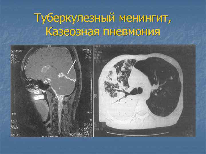 Туберкулезный менингит, Казеозная пневмония 