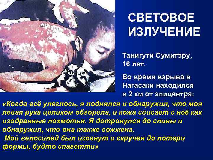СВЕТОВОЕ ИЗЛУЧЕНИЕ Танигути Сумитэру, 16 лет. Во время взрыва в Нагасаки находился в 2