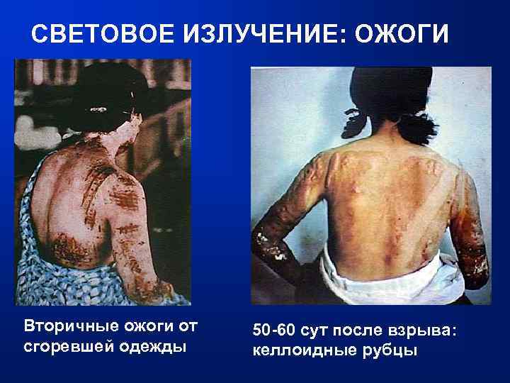 СВЕТОВОЕ ИЗЛУЧЕНИЕ: ОЖОГИ Вторичные ожоги от сгоревшей одежды 50 -60 сут после взрыва: келлоидные