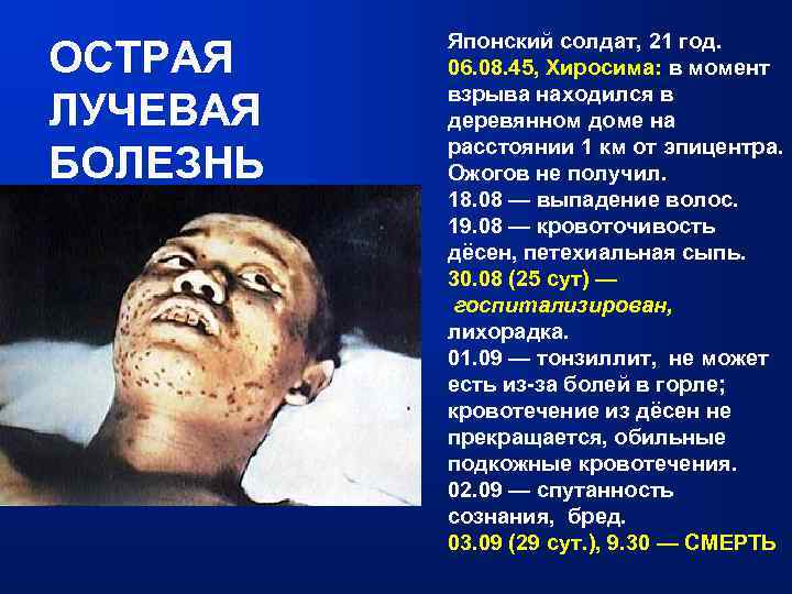 ОСТРАЯ ЛУЧЕВАЯ БОЛЕЗНЬ Японский солдат, 21 год. 06. 08. 45, Хиросима: в момент взрыва