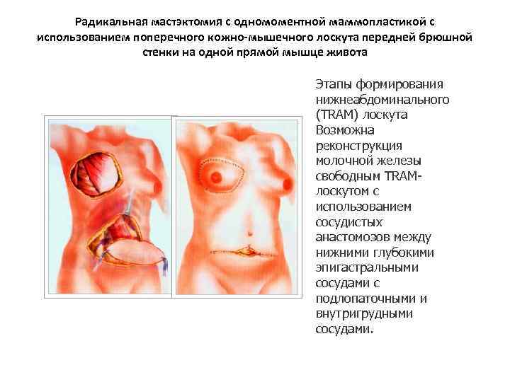 Радикальная мастэктомия с одномоментной маммопластикой с использованием поперечного кожно-мышечного лоскута передней брюшной стенки на