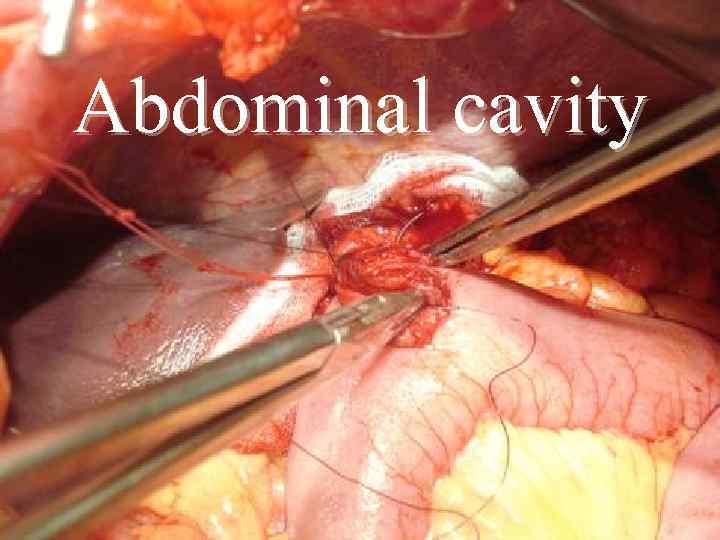 Аbdominal cavity 