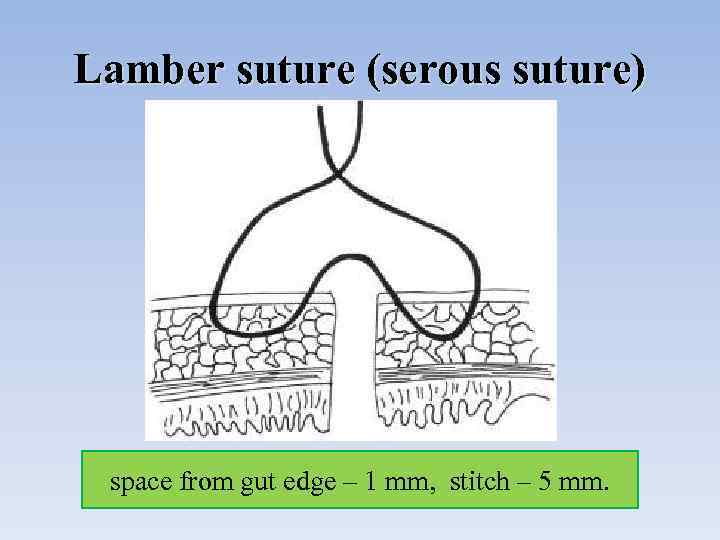 Lamber suture (serous suture) space from gut edge – 1 mm, stitch – 5