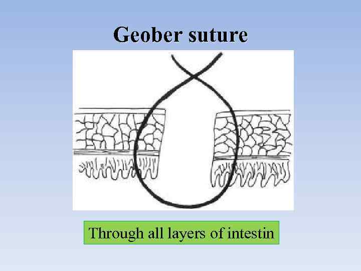 Geober suture Through all layers of intestin 