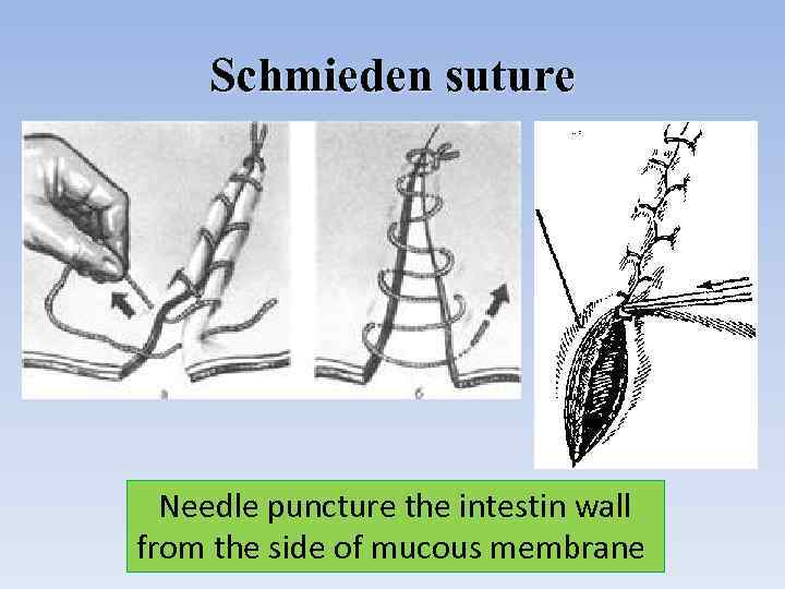 Schmieden suture Needle puncture the intestin wall from the side of mucous membrane 