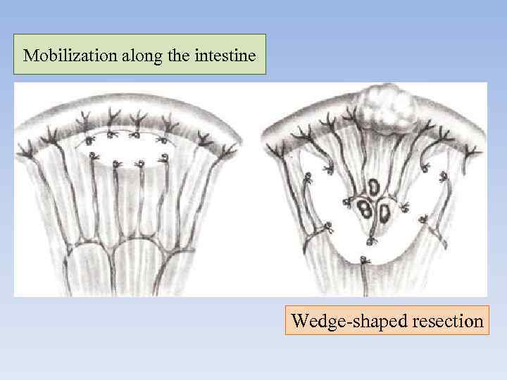 Mobilization along the intestine Wedge-shaped resection 