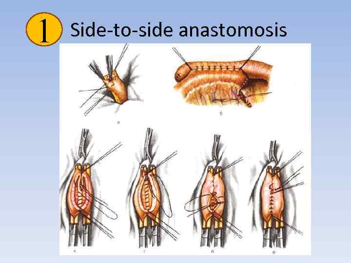 1 Side-to-side anastomosis 