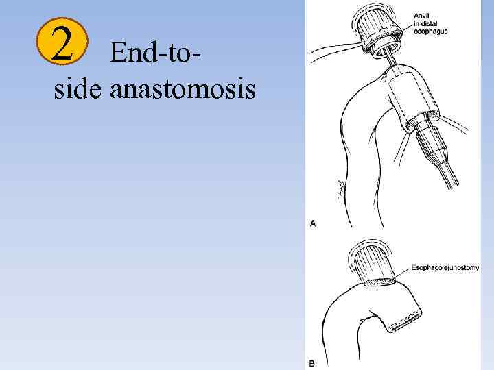 2 End-toside anastomosis 