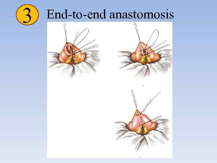 3 End-to-end anastomosis 