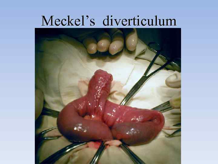 Meckel’s diverticulum 