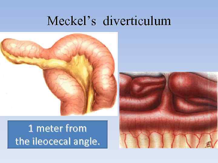 Meckel’s diverticulum 1 meter from the ileocecal angle. 