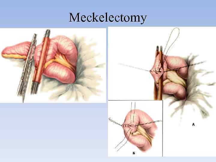 Meckelectomy 