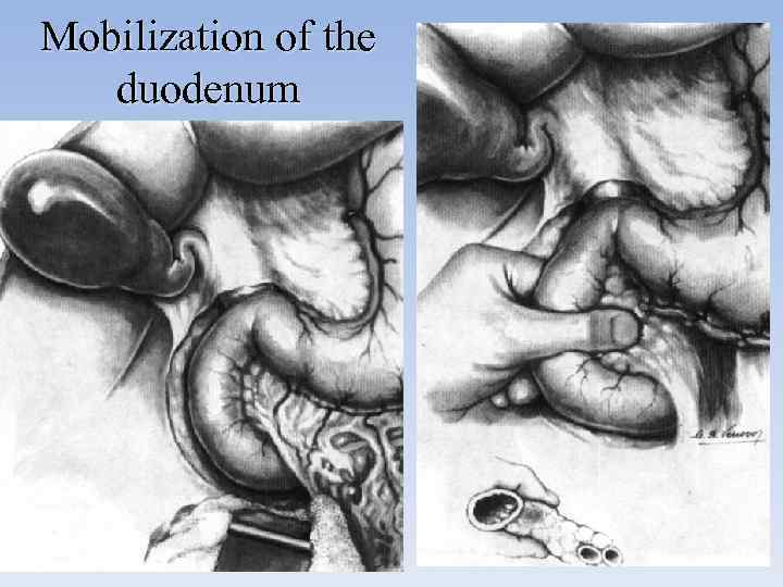 Mobilization of the duodenum 