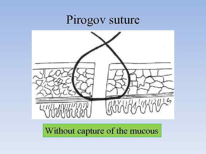 Pirogov suture Without capture of the mucous 