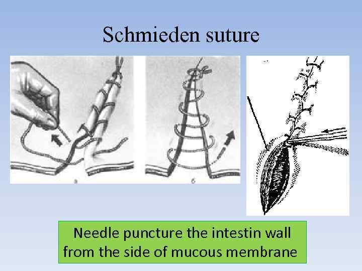 Schmieden suture Needle puncture the intestin wall from the side of mucous membrane 