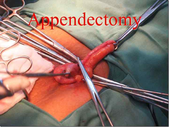 Appendectomy 