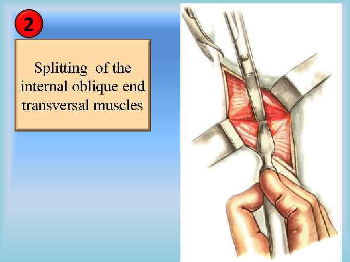 2 Splitting of the internal oblique end transversal muscles 