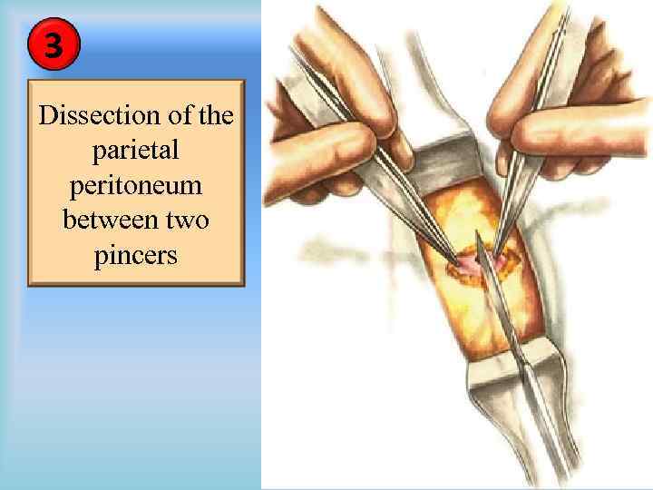 3 Dissection of the parietal peritoneum between two pincers 