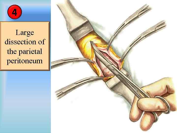 4 Large dissection of the parietal peritoneum 