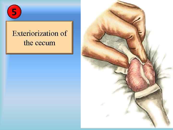 5 Exteriorization of the cecum 