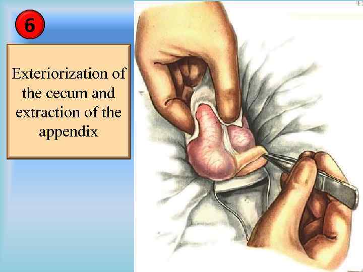 6 Exteriorization of the cecum and extraction of the appendix 