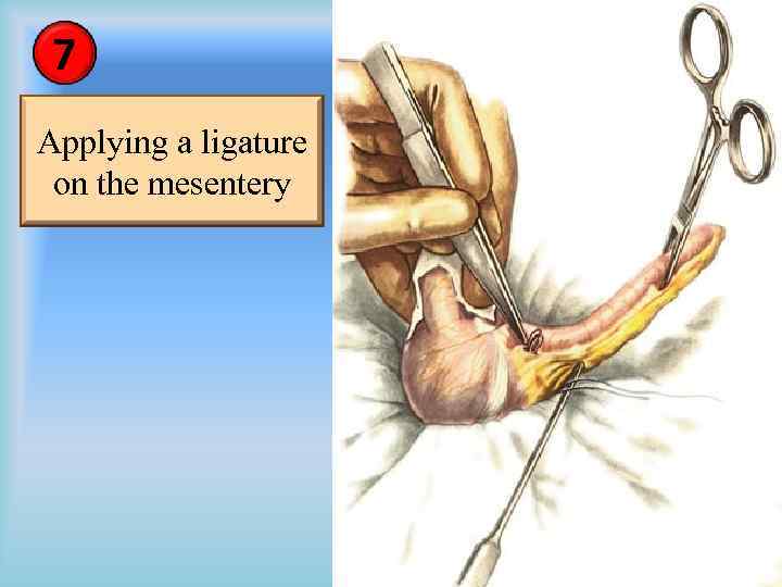 7 Applying a ligature on the mesentery 